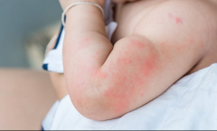 患有荨麻疹太难受，该如何解决？益生菌就是帮手！